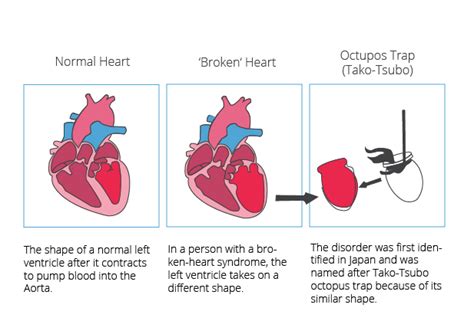 Heart conditions: Broken heart syndrome | CardioSecur