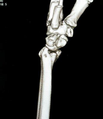 Ct scan right wrist joint 3d view shows right distal radius fracture • wall stickers x-ray ...