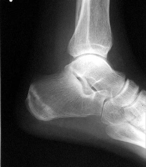 CALCANEAL STRESS FRACTURE | Buyxraysonline