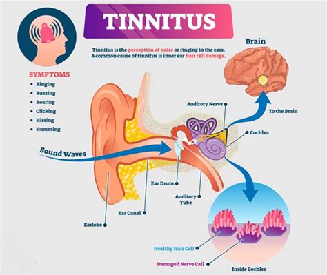 UNDIAGNOSED VITAMIN B12 DEFICIENCY?: TINNITUS: