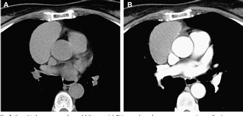 Figure 1 from Prediction of thymoma histology and stage by radiographic criteria. | Semantic Scholar