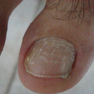 Proximal white subungual onychomycosis | Download Scientific Diagram