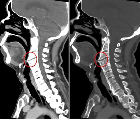 Diffuse idiopathic skeletal hyperostosis DISH | OsteoMag