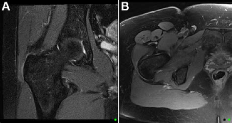 MRI scans of a patient with gluteal tendinopathy and an MHIP score of 2 ...