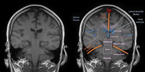 Diagram of Coronal MRI brain (T1) | Quizlet