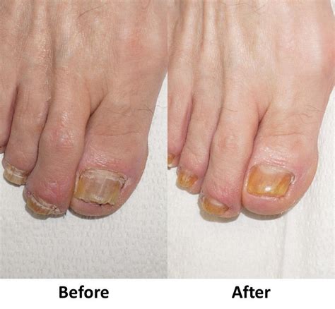 Laser toenail fungus treatment