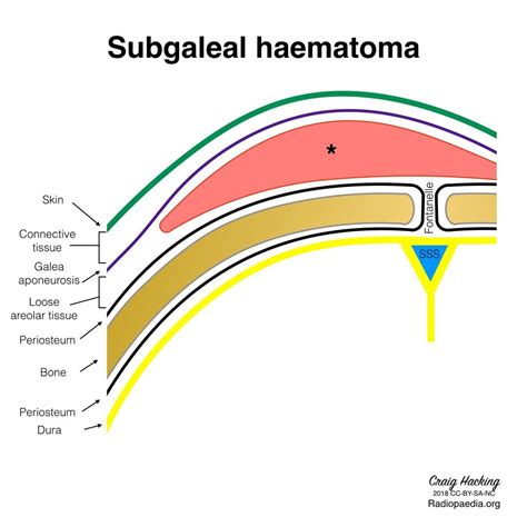 Subgaleal haematoma | Radiology, Scalps, Obstetrics