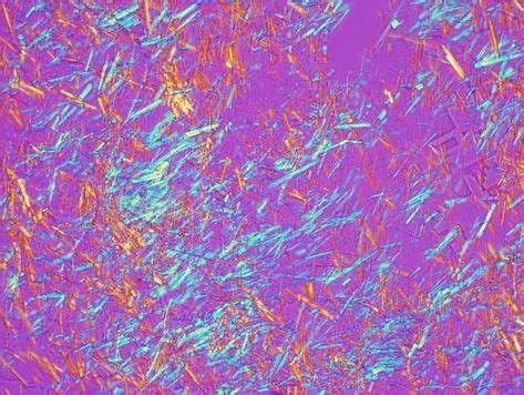 Monosodium urate crystals (Gout) under polarizing light microscopy ...