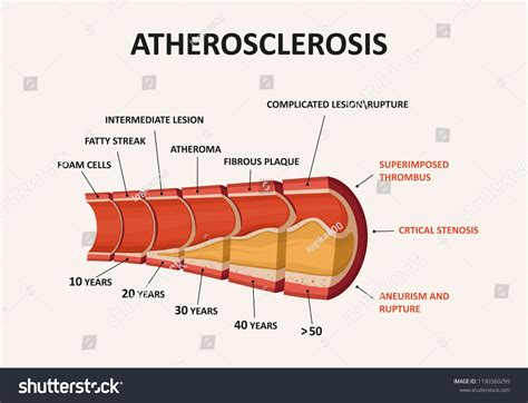 10,667 Atherosclerosis 이미지, 스톡 사진 및 벡터 | Shutterstock