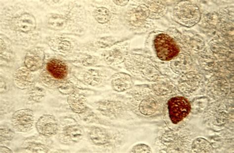 Chlamydophila trachomatis - wikidoc