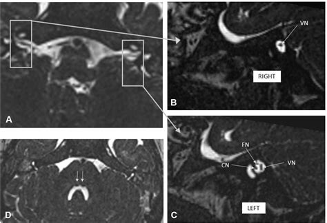 Unilateral facial nerve hypoplasia without evident facial palsy | BMJ Case Reports