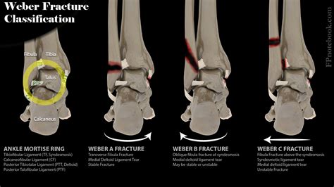 Weber Fracture