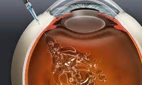 Avastin treatment for macular degeneration and retinal vein occlusion