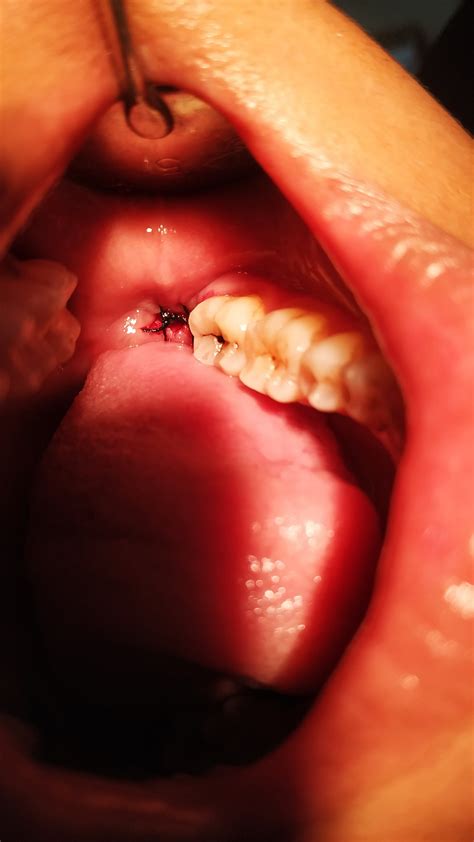 Is a Wisdom Tooth Removal Surgery Worth the Pain? - favourite dentistry