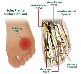 About Morton’s Neuroma - The Center for Mortons Neuroma