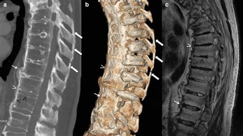 Ankylosing Spondylitis Mri