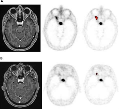 Optic nerve sheath meningioma. A Pre-RT imaging: T1 post-contrast MRI ...