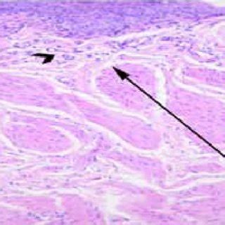 Fluid-filled cavity ( ) and intraepithelial cysts of various sizes (S)... | Download Scientific ...