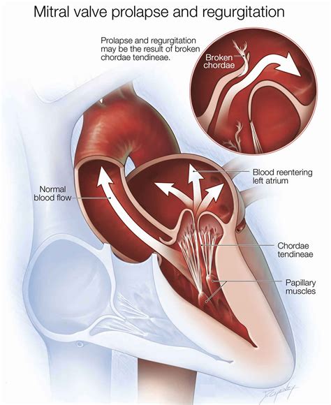 Mitral valve regurgitation causes, symptoms, diagnosis, treatment & prognosis