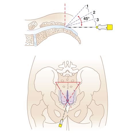 Caudal Anesthesia Technique