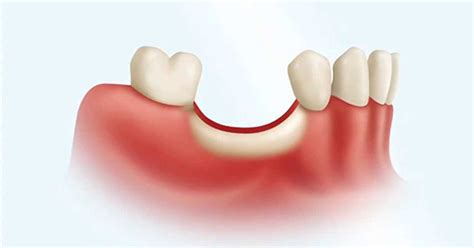 Ridge Augmentation | Dental Associates of Arlington