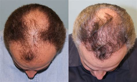 Hair Transplant Before & After #4 - Jesse E Smith, MD, FACS – Ft Worth ...