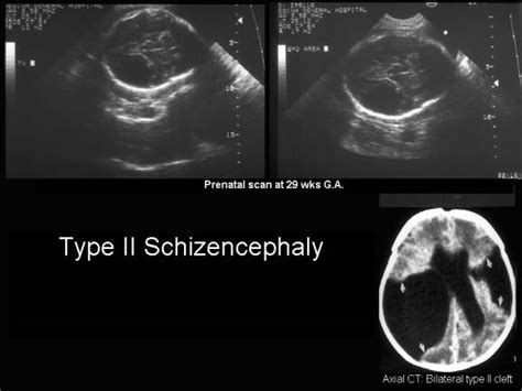 Schizencephaly Ultrasound