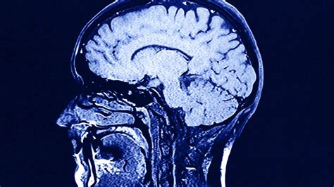 Lissencephaly (Smooth brain): Overview, symptoms, causes, and more