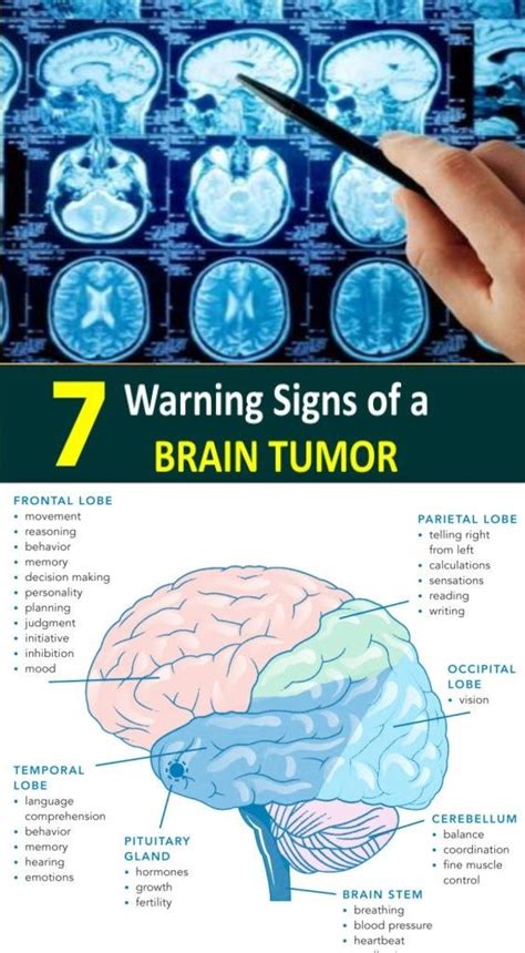 7 warning signs of a brain tumor - Healthy Lifestyle