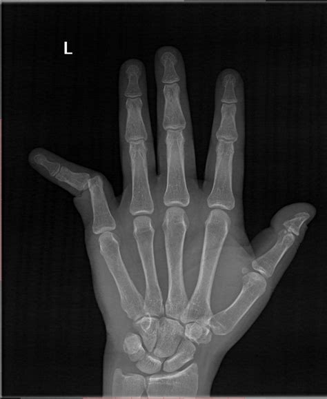 Phalanx Dislocations - Hand - Orthobullets