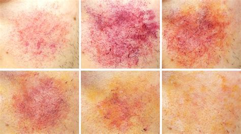Coloring Stages of Bruises | Faculty of Medicine