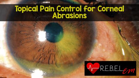 Topical Pain Control for Corneal Abrasions - REBEL EM - Emergency ...