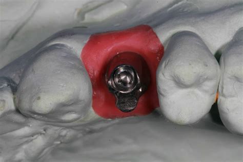 UCLA Custom Abutment - Advanced Dentistry & Dental Implant Center