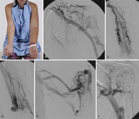 Vascular Anomalies | Radiology Key