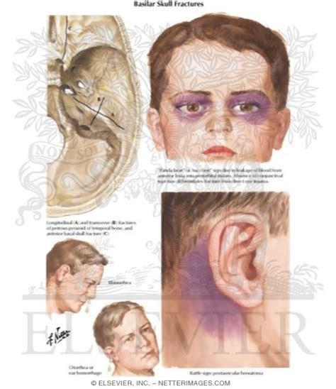 Basilar Skull Fractures