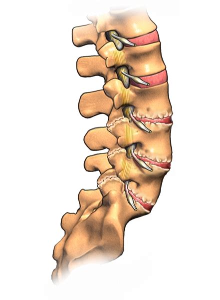 Degenerative Disc Disease | Knock Out Pain