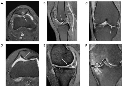 Mri Knee Cartilage Damage