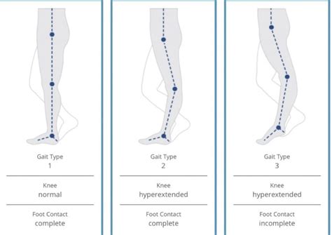 Banana Knee: Hypermobility Leading to Dysfunction and Vice Versa — BE