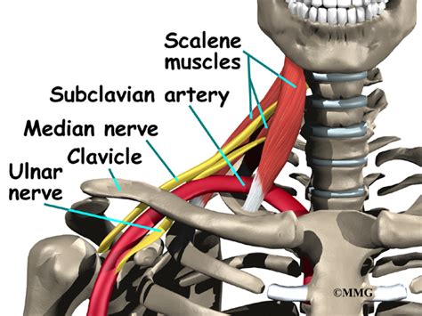 Thoracic Outlet Syndrome - Morphopedics