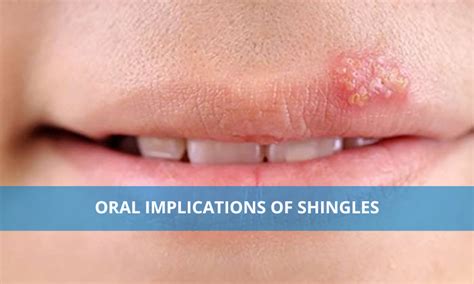 Shingles On Lips And Nose | Lipstutorial.org