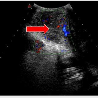 Ultrasound: scrotum -image 3 The image demonstrates increased and ...