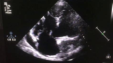 Large VSD with PDA, PFO and tortuous aorta (Echocardiography) - YouTube