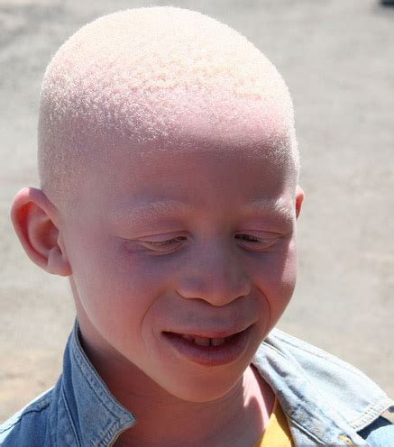 Albinism in humans - Wikipedia