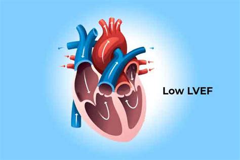 low ejection fraction treatment| Heart Blockages Ayurvedic Doctor