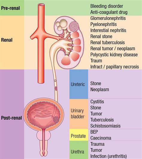 causes of Hematuria - MEDizzy