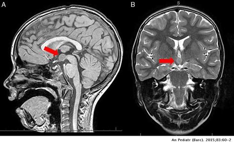 Forms of clinical presentation of hypothalamic hamartoma | Anales de ...