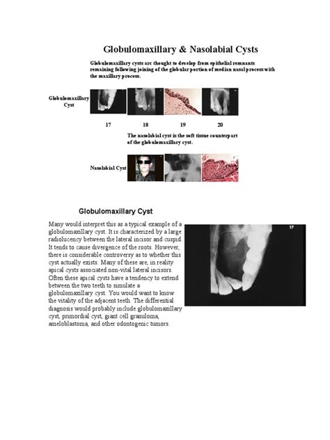 Globulomaxillary - Nasolabial Cyst | PDF | Epithelium | Diseases And ...