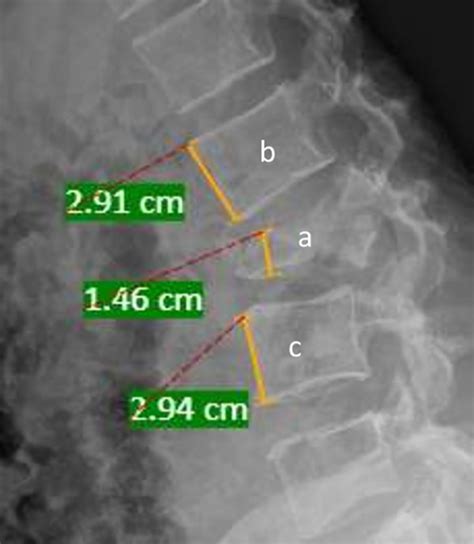 Functional Outcomes of Nerve Root Sparing Posterior Corpectomy in ...