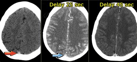 The Radiology Assistant : Cerebral Venous Thrombosis