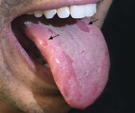 Syphilis Chancre Tongue